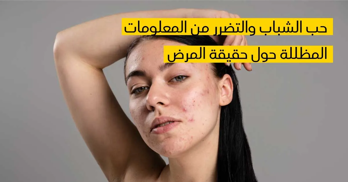 حب الشباب والتضرر من المعلومات المظللة حول حقيقة المرض